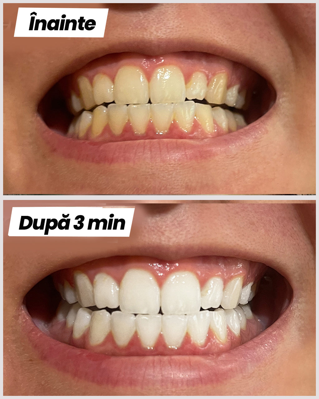 GoSmile™ Ultra | Roz