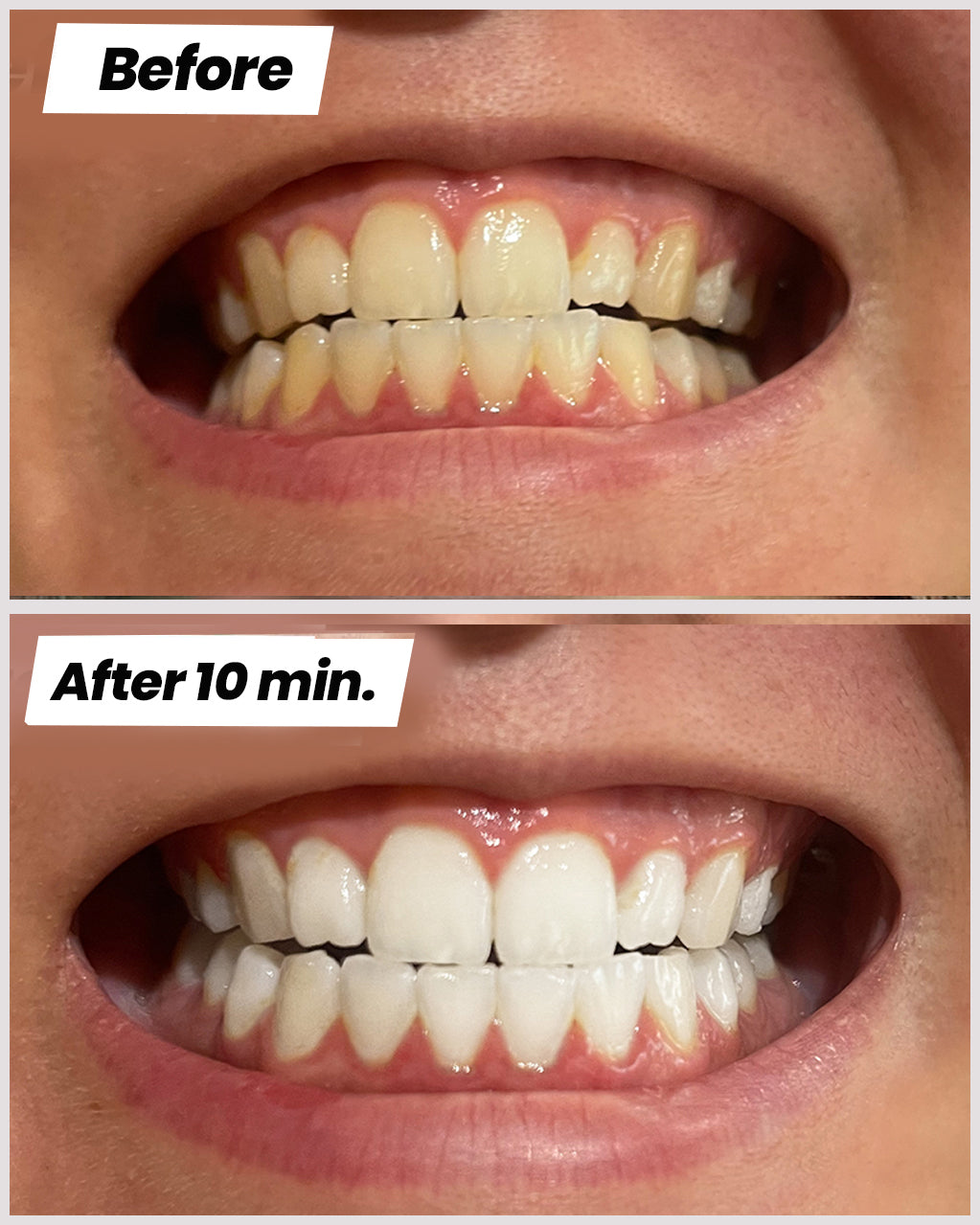 IO Teeth Whitening Kit™